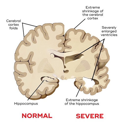 Dementia Brain Shrinkage.jpg